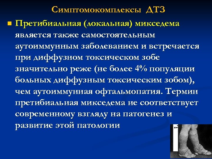 Симптомокомплексы ДТЗ n Претибиальная (локальная) микседема является также самостоятельным аутоиммунным заболеванием и встречается при