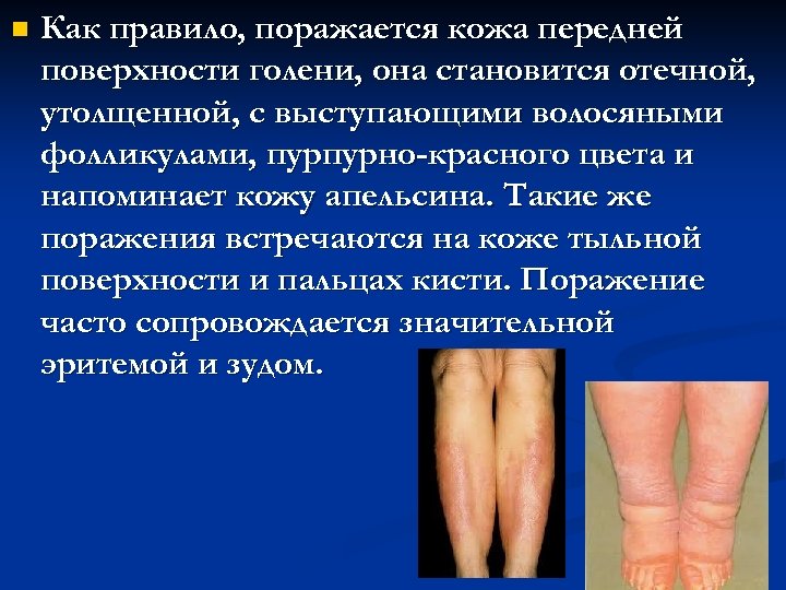 n Как правило, поражается кожа передней поверхности голени, она становится отечной, утолщенной, с выступающими