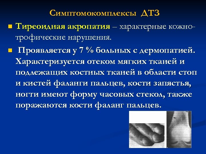 Симптомокомплексы ДТЗ n Тиреоидная акропатия – характерные кожнотрофические нарушения. n Проявляется у 7 %