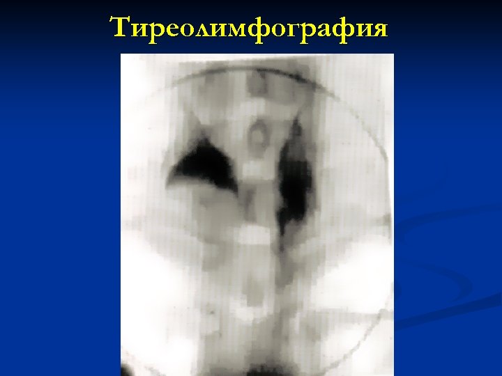 Тиреолимфография 