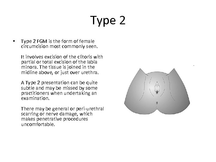 Type 2 • Type 2 FGM is the form of female circumcision most commonly