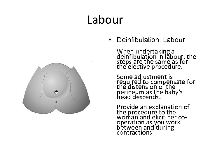 Labour • Deinfibulation: Labour When undertaking a deinfibulation in labour, the steps are the