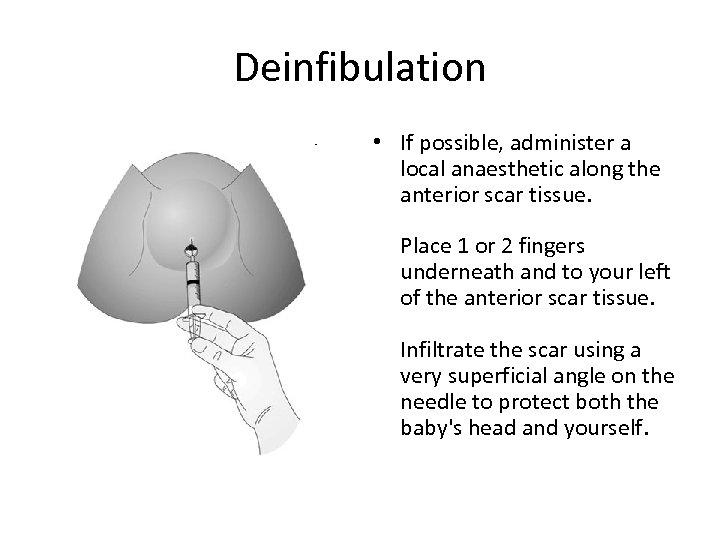 Deinfibulation • If possible, administer a local anaesthetic along the anterior scar tissue. Place