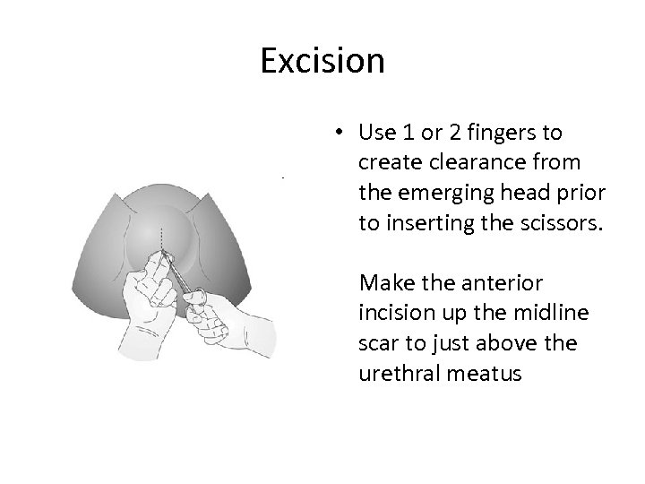 Excision • Use 1 or 2 fingers to create clearance from the emerging head