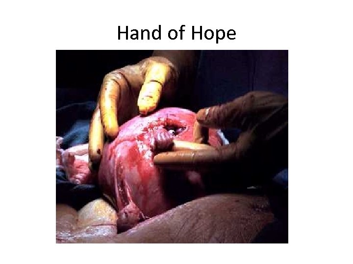 Hand of Hope 