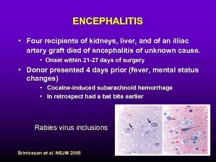 ENCEPHALITIS • Four recipients of kidneys, liver, and of an illiac artery graft died