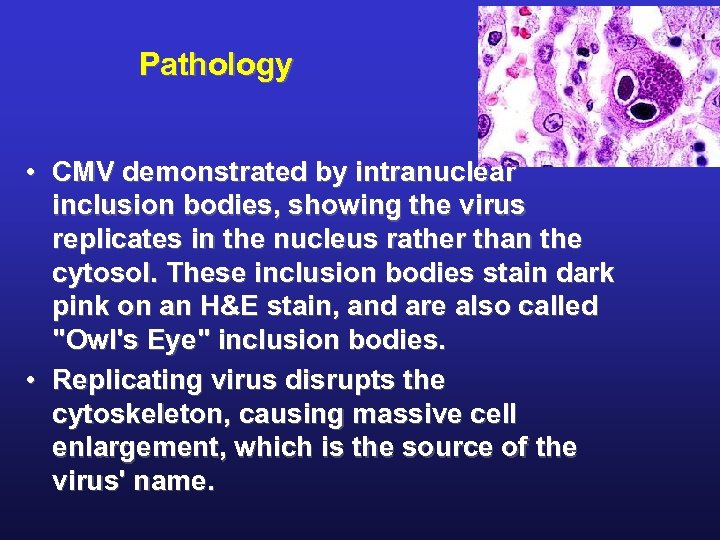 Pathology • CMV demonstrated by intranuclear inclusion bodies, showing the virus replicates in the