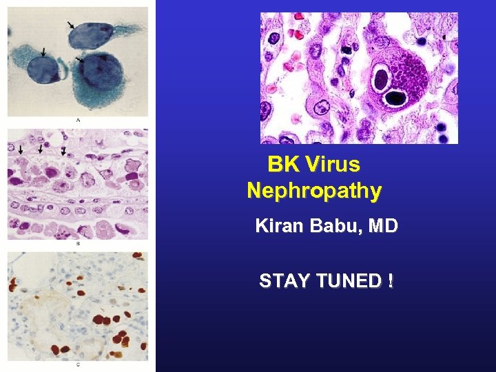 BK Virus Nephropathy Kiran Babu, MD STAY TUNED ! 