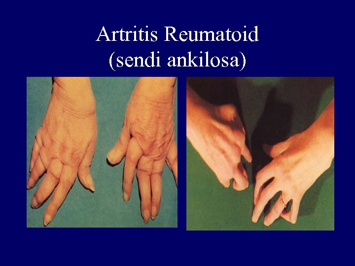 Artritis Reumatoid (sendi ankilosa) 