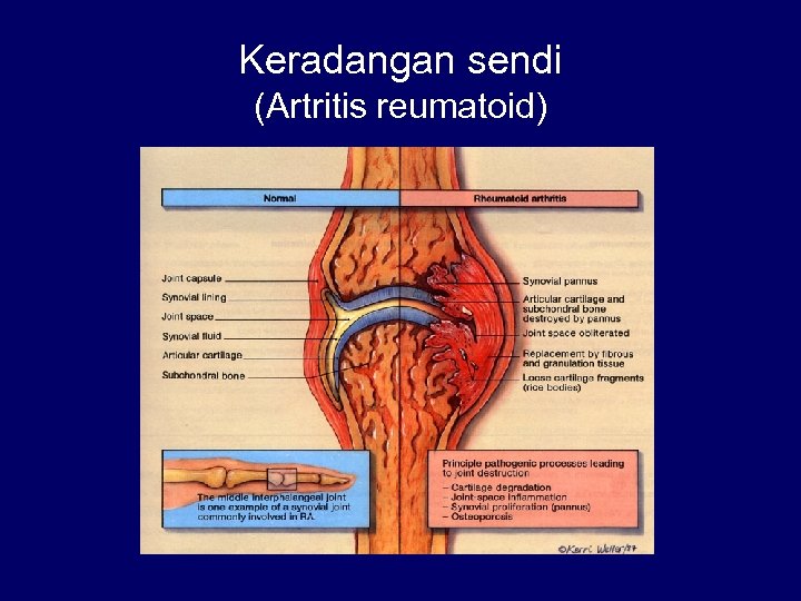 Keradangan sendi (Artritis reumatoid) 