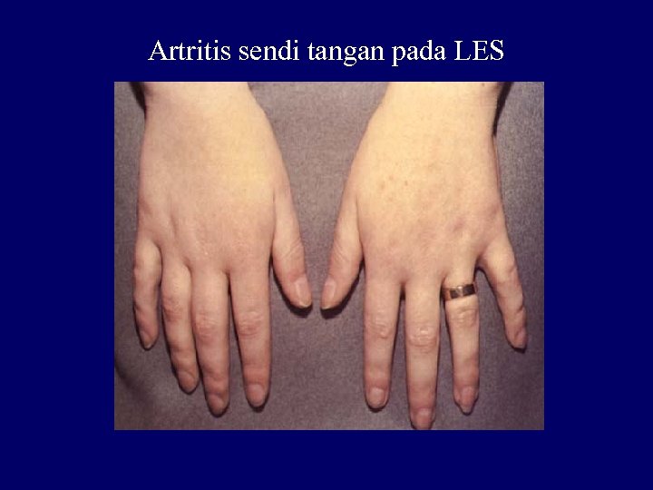 Artritis sendi tangan pada LES 