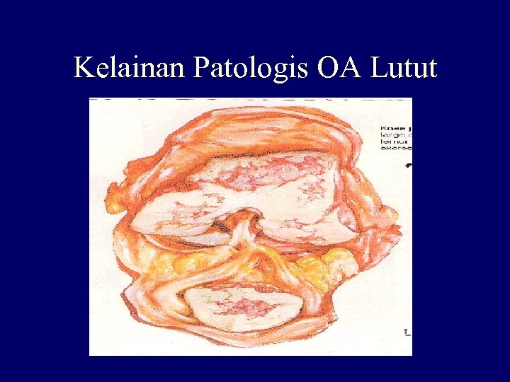 Kelainan Patologis OA Lutut 