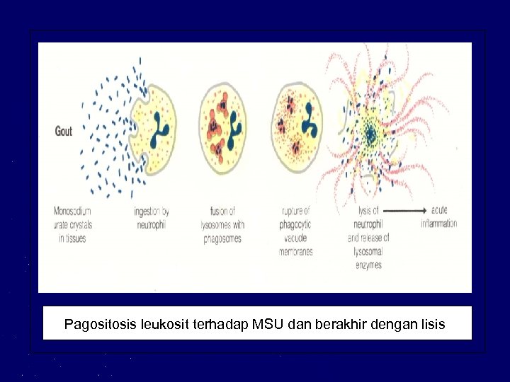 Pagositosis leukosit terhadap MSU dan berakhir dengan lisis 