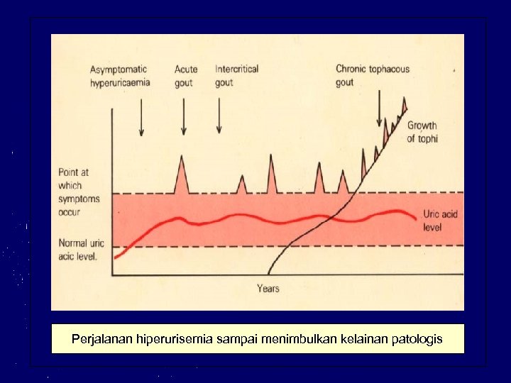 Perjalanan hiperurisemia sampai menimbulkan kelainan patologis 