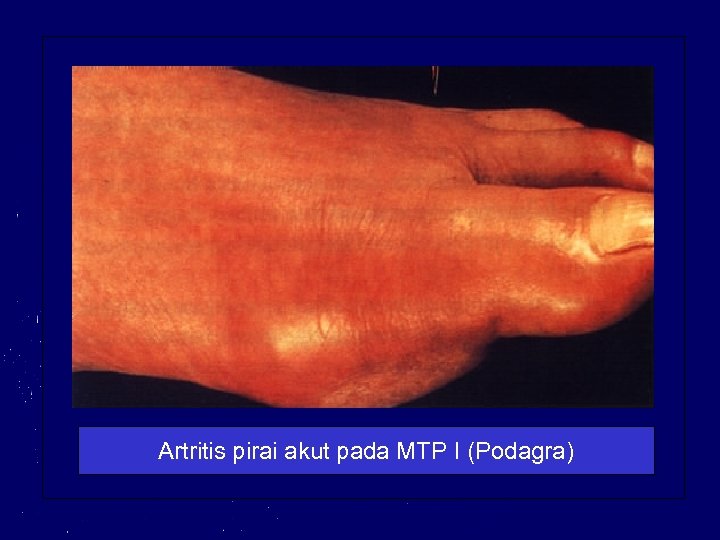 Artritis pirai akut pada MTP I (Podagra) 