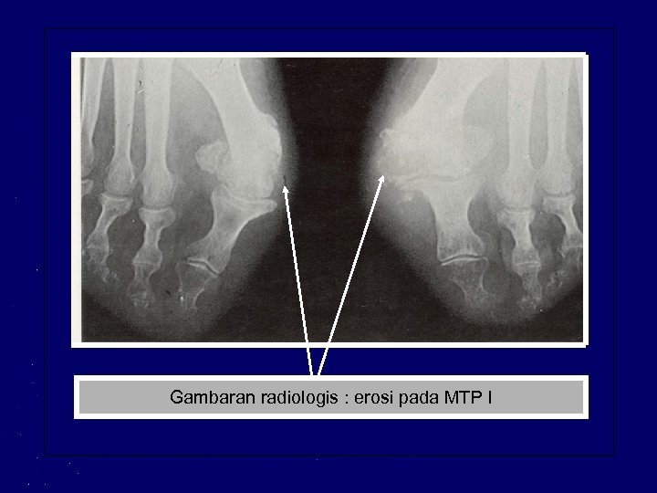 Gambaran radiologis : erosi pada MTP I 