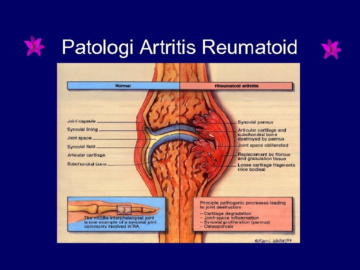 Patologi Artritis Reumatoid 