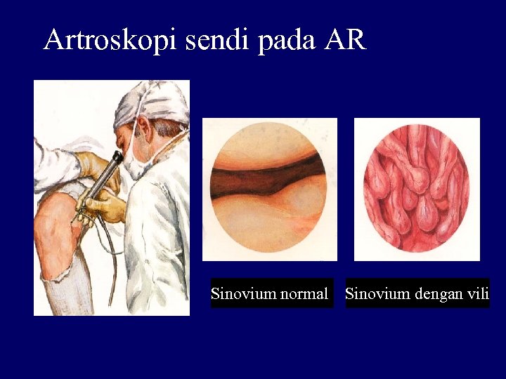 Artroskopi sendi pada AR Sinovium normall Sinovium dengan vili 