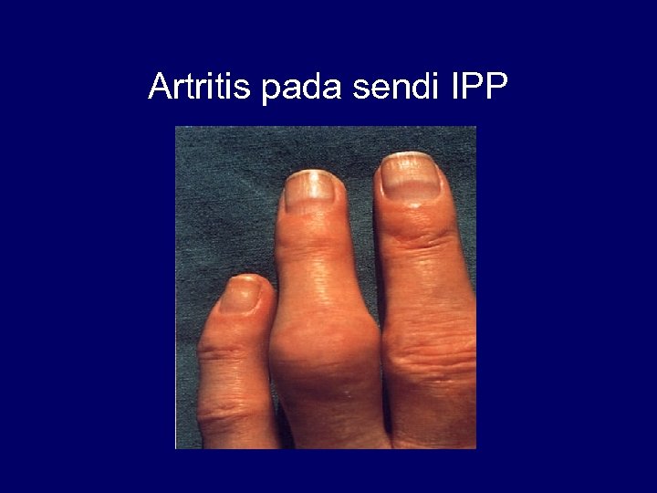 Artritis pada sendi IPP 