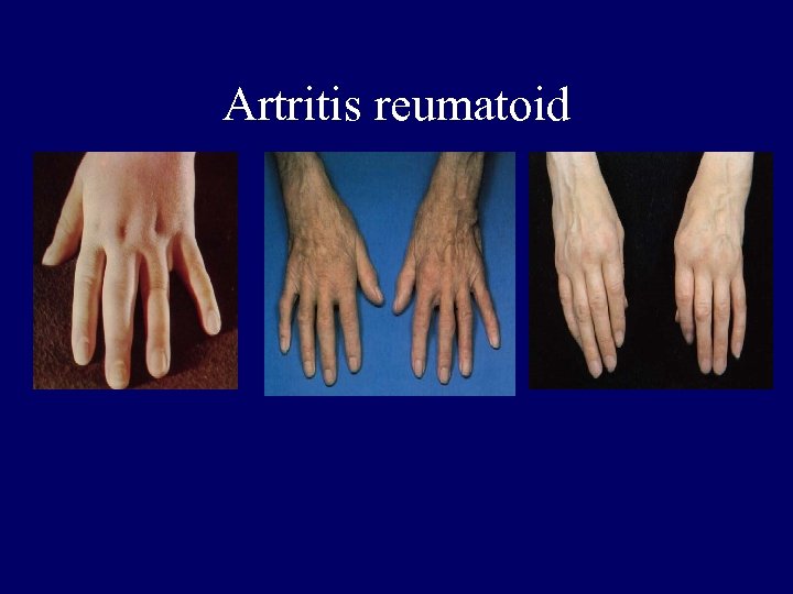 Artritis reumatoid 