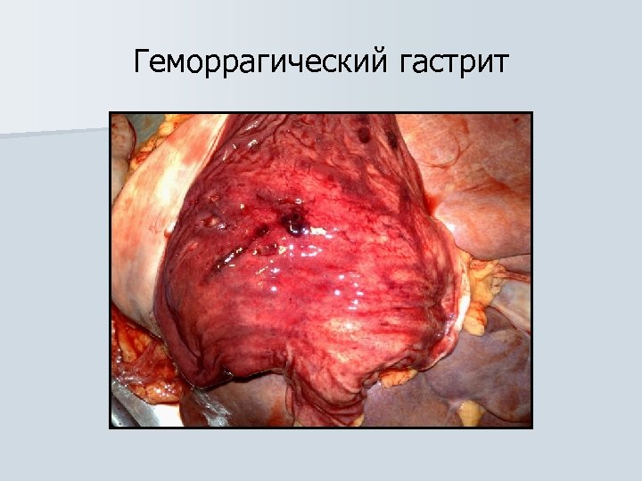 Геморрагический гастрит 