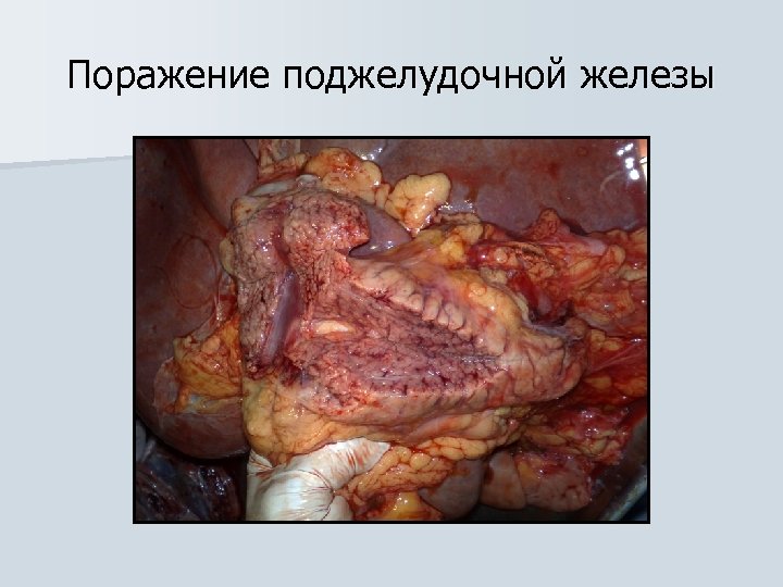 Поражение поджелудочной железы 