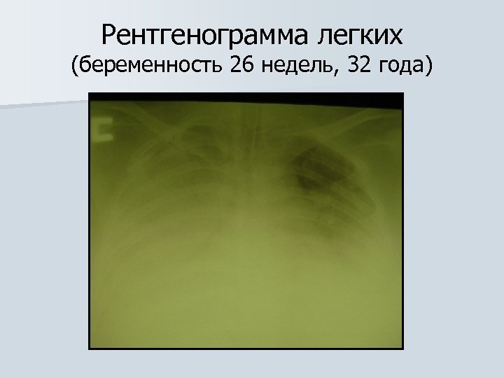Рентгенограмма легких (беременность 26 недель, 32 года) 