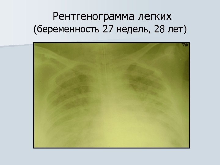  Рентгенограмма легких (беременность 27 недель, 28 лет) 