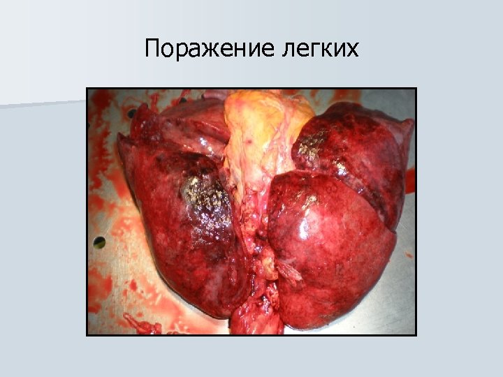 Поражение легких 