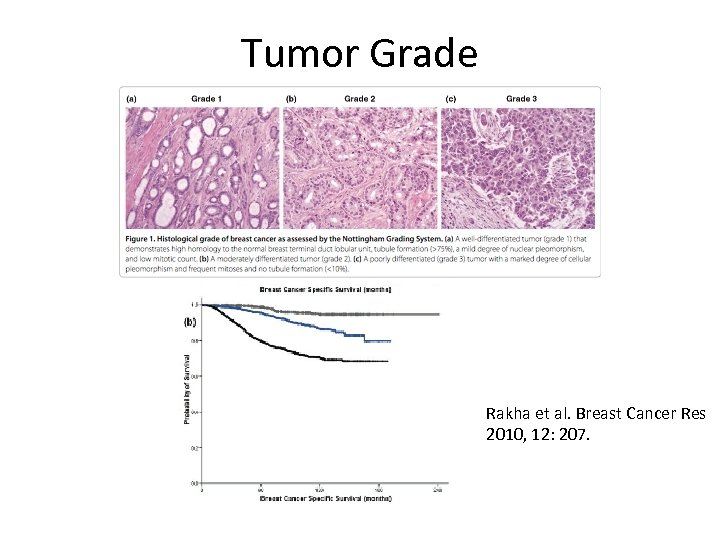 Tumor Grade Rakha et al. Breast Cancer Res 2010, 12: 207. 