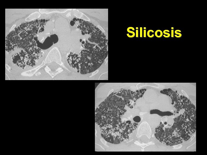 Silicosis 