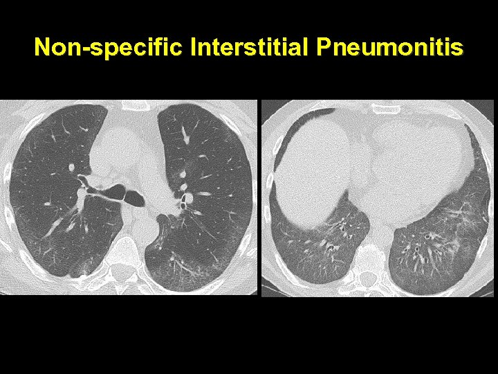Non-specific Interstitial Pneumonitis 