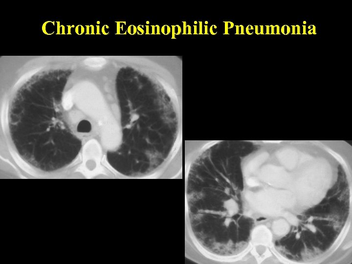 Chronic Eosinophilic Pneumonia 