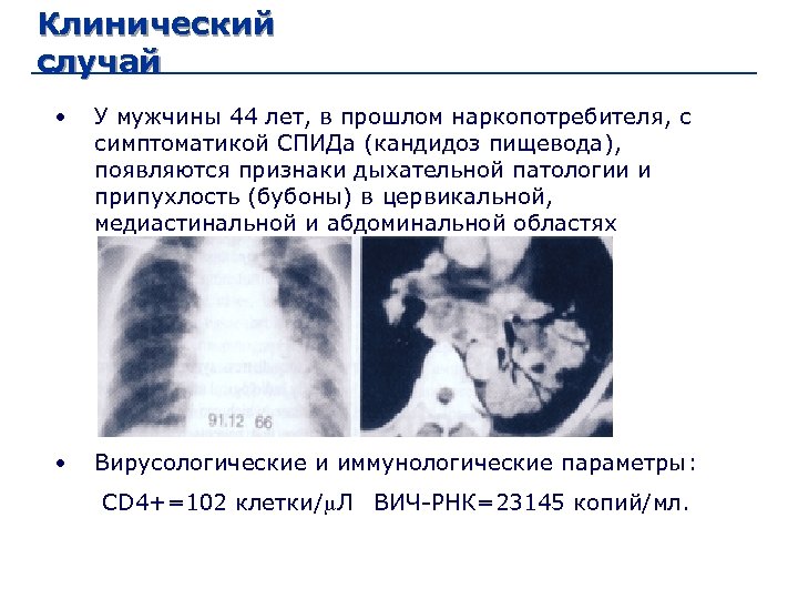 Клинический случай • У мужчины 44 лет, в прошлом наркопотребителя, с симптоматикой СПИДа (кандидоз