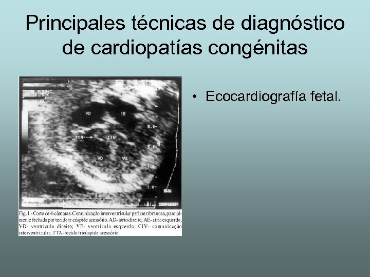 Principales técnicas de diagnóstico de cardiopatías congénitas • Ecocardiografía fetal. 