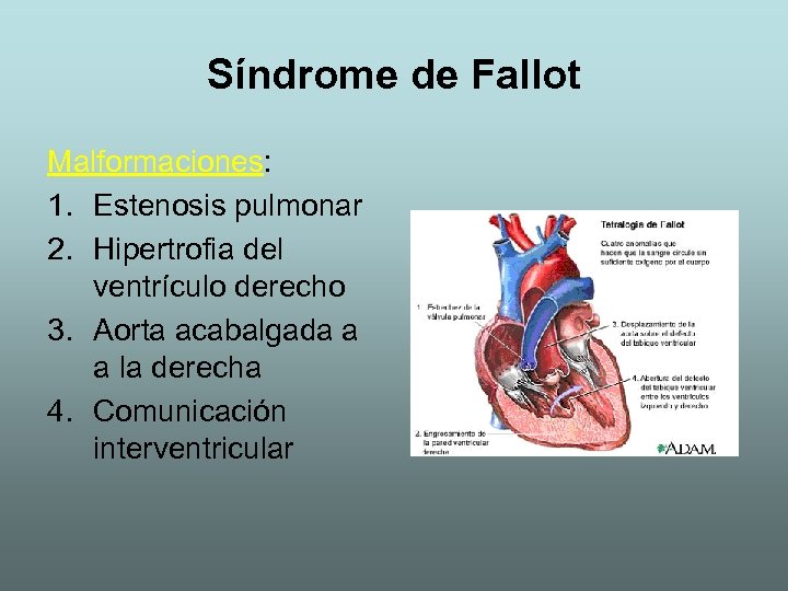 Síndrome de Fallot Malformaciones: 1. Estenosis pulmonar 2. Hipertrofia del ventrículo derecho 3. Aorta
