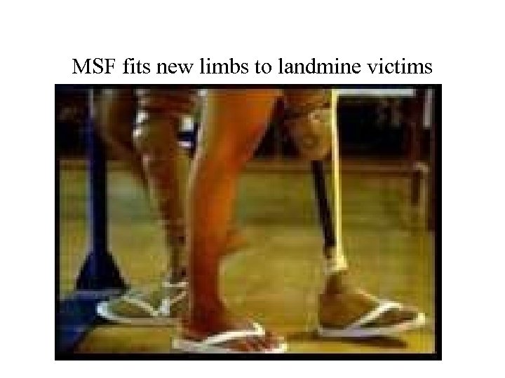 MSF fits new limbs to landmine victims 