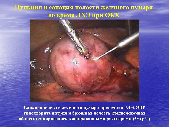 Пункция и санация полости желчного пузыря во время ЛХЭ при ОКХ Санация полости желчного