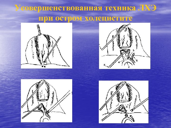 Усовершенствованная техника ЛХЭ при остром холецистите 