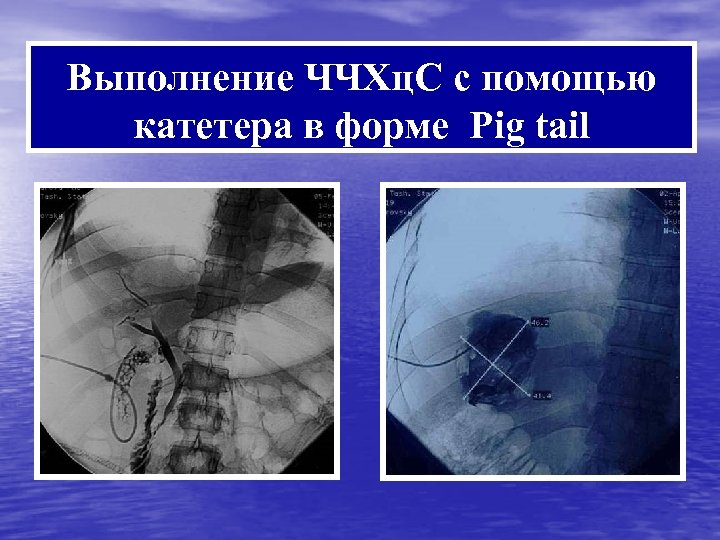 Выполнение ЧЧХц. С с помощью катетера в форме Рig tail 