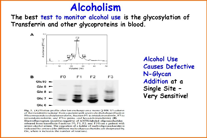 Alcoholism The best to monitor alcohol use is the glycosylation of Transferrin and other