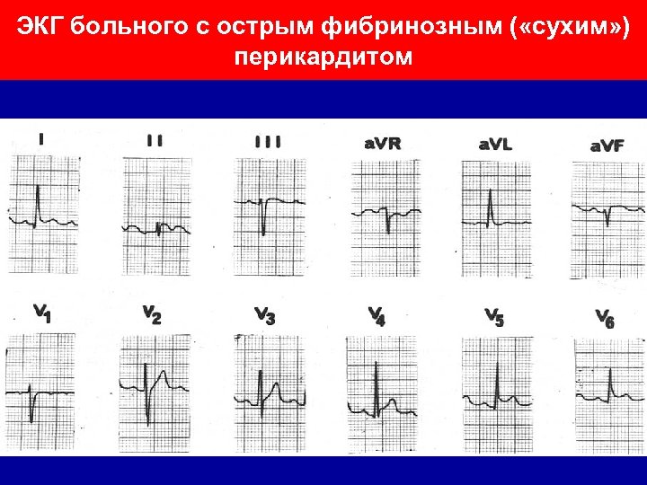 Перикардит экг картина