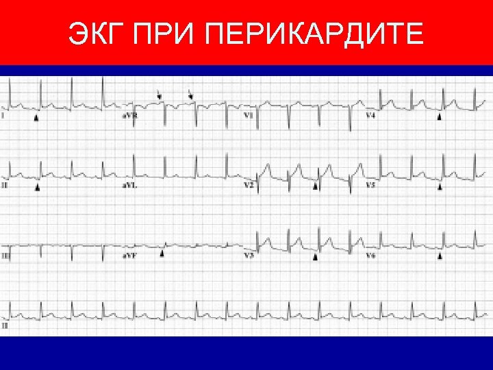 Перикардит экг картина