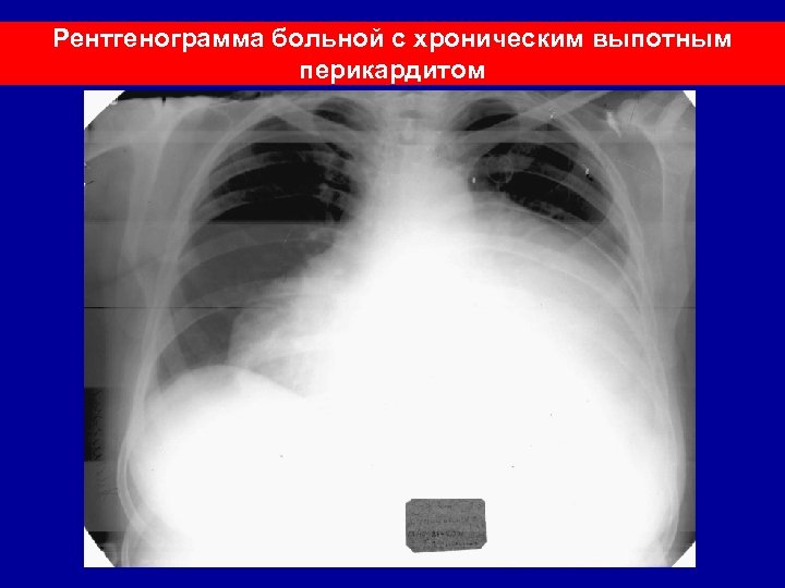 При выпотном перикардите на рентгенограмме наблюдается легочный рисунок тест ответ