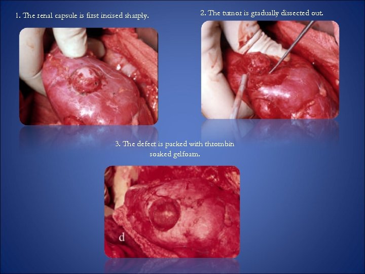 1. The renal capsule is first incised sharply. 2. The tumor is gradually dissected