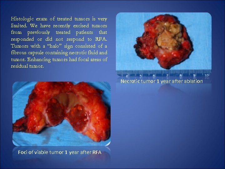 Histologic exam of treated tumors is very limited. We have recently excised tumors from