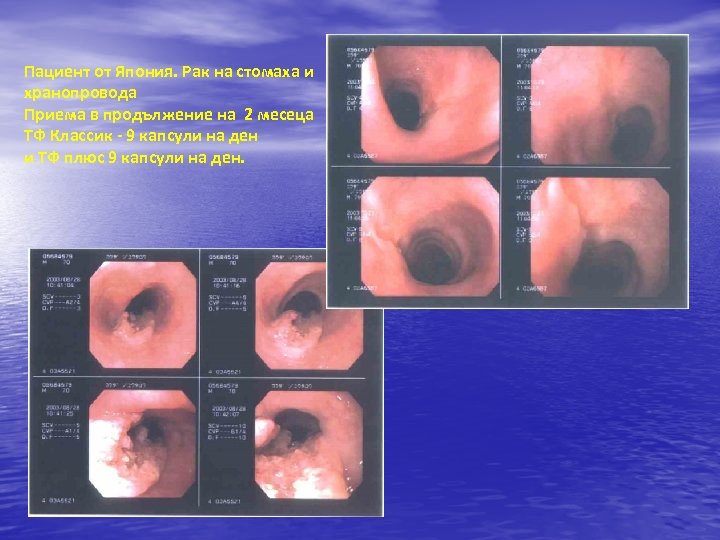 Пациент от Япония. Рак на стомаха и хранопровода Приема в продължение на 2 месеца