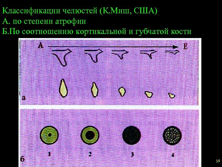 Классификации челюстей (К. Миш, США) А. по степени атрофии Б. По соотношению кортикальной и