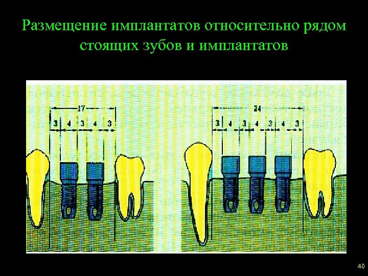 Размещение имплантатов относительно рядом стоящих зубов и имплантатов 40 