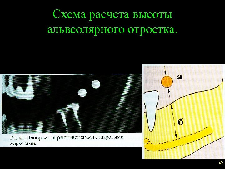 Схема расчета высоты альвеолярного отростка. 42 